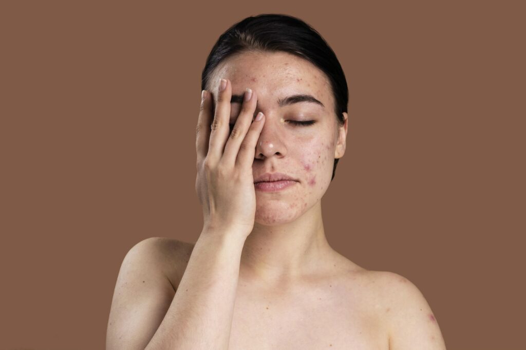 acne-prone skin