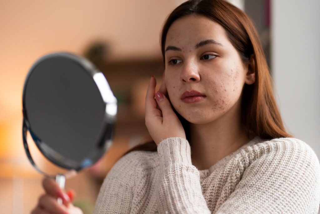 acne-prone skin