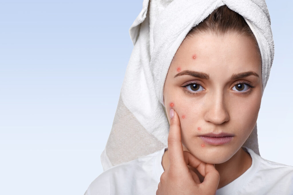 acne-prone skin